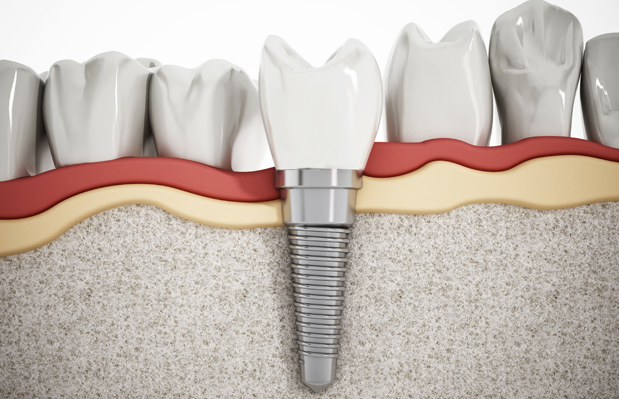 What Are Dental Implants